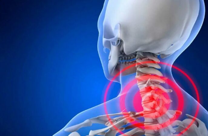 Mugurkaula kakla mugurkaula osteohondroze