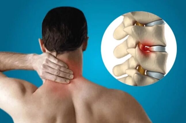 Mugurkaula osteohondroze