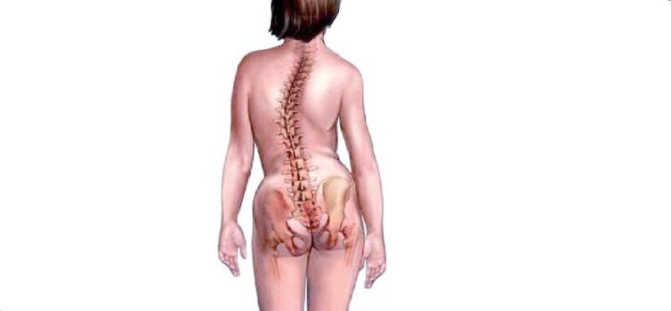 osteohondroze
