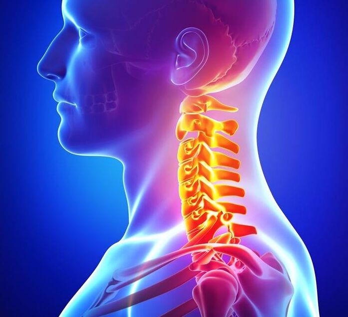 Dzemdes kakla mugurkaula osteohondroze