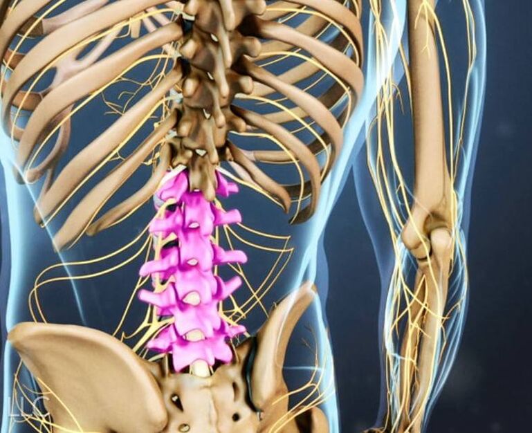 Mugurkaula jostas daļas osteohondroze